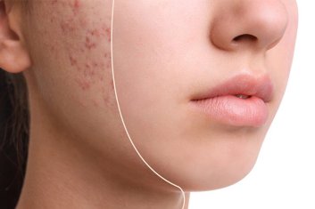 Yüzümdeki Lekeleri Nasıl Yok Edebilirim?